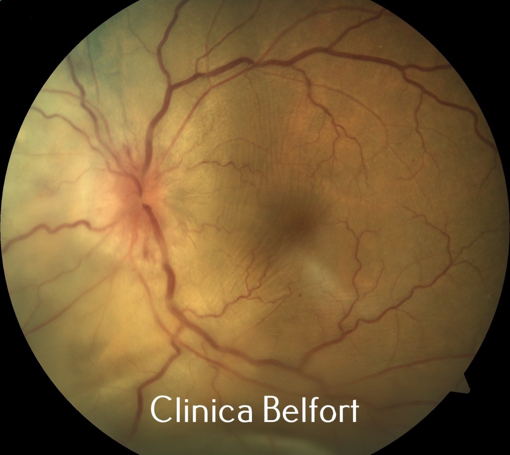 Foto de Metástase ocular