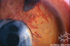 Foto de olho com Glaucoma