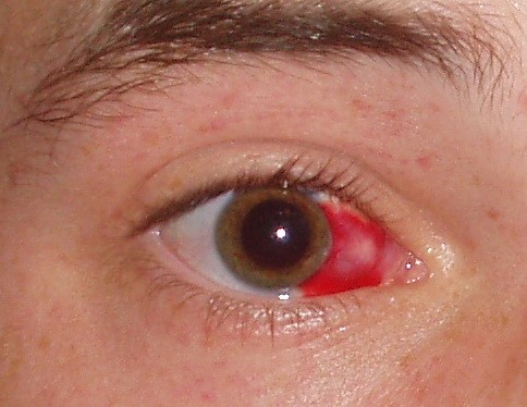 Foto de Hipoasfagma (derrame ocular)