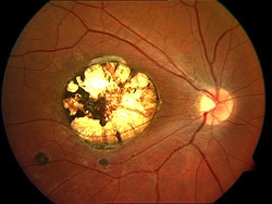 Foto de Toxoplasmose Ocular