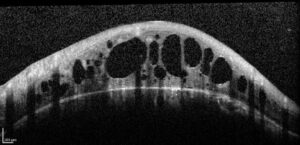 Exame de OCT alterado mostrando edema cistóide