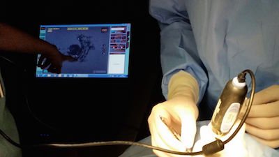 braquiterapia ocular