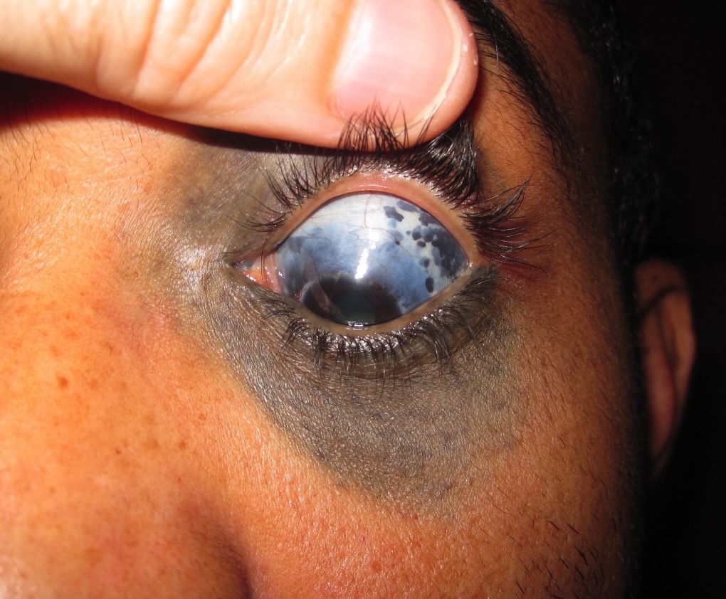 melanocitose oculodermal