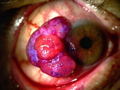 Carcinomas oculares da conjuntiva