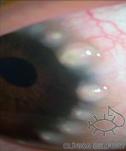 olho com alterações causadas pela alergia ocular