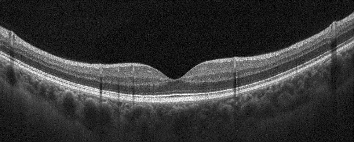 normal retina oct image